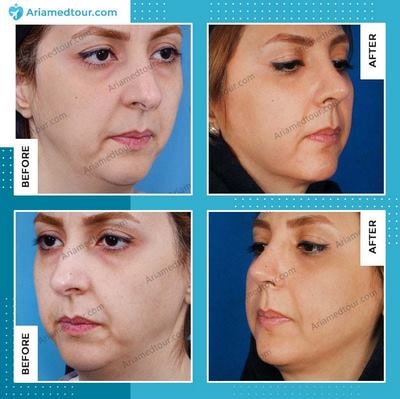 chin augmentation before after photo in Iran