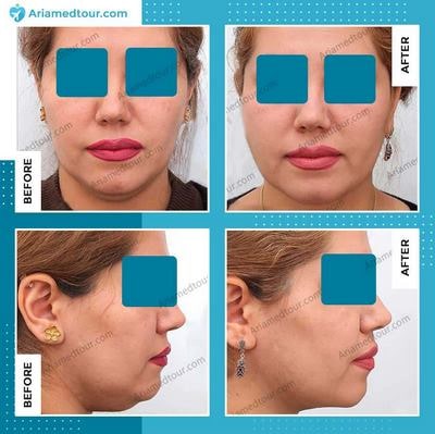 double chin surgery in Iran before and after