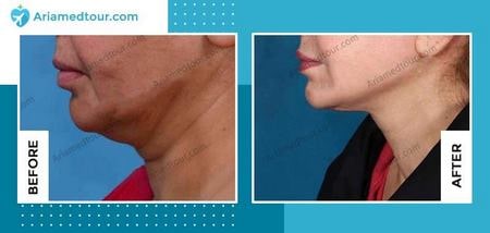 chin surgery in iran before and after