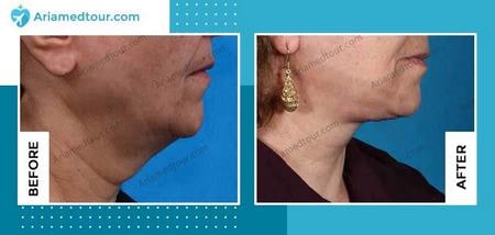 chin fat removal in iran before and after