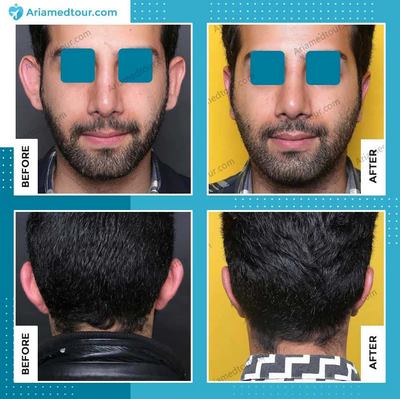 ear surgery before after photo in Iran