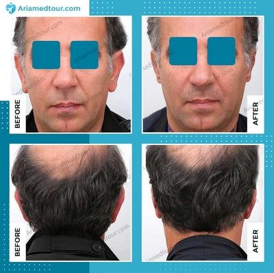 ear surgery in Iran before after photo