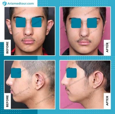 otoplasty in Iran before after photo