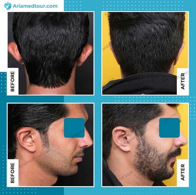 Iran ear surgery before after photo