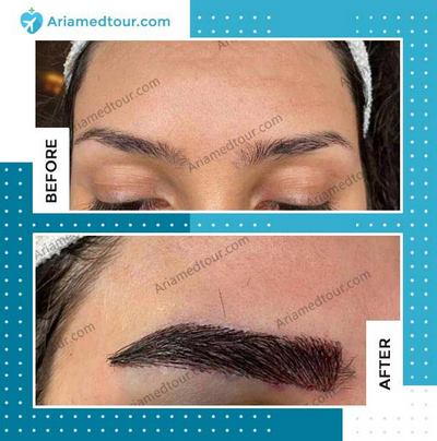 eyebrow transplant in Iran before and after photo