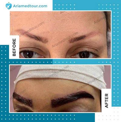 eyebrow transplant before after photo in Iran