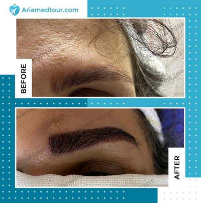 eyebrow transplant before after photo in Iran