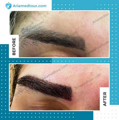 eyebrow transplant in Iran before and after photo