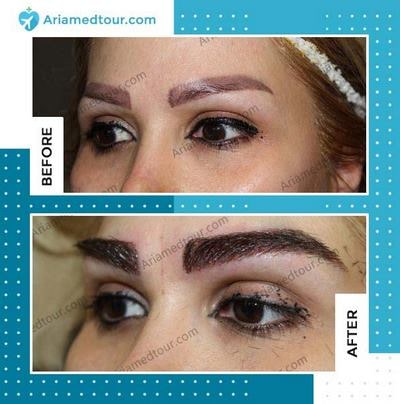 eyebrow transplantation in Iran before and after photo