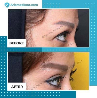 Eyelid Surgery before and after photo in Iran
