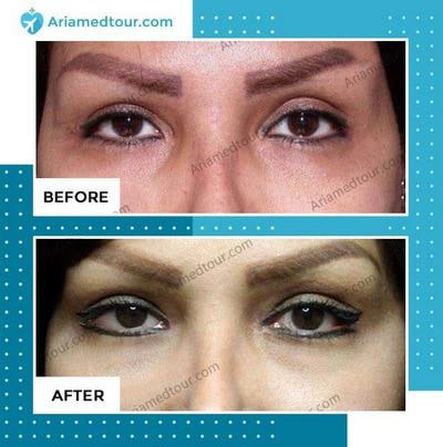 Eyelid Surgery before and after photo in Iran
