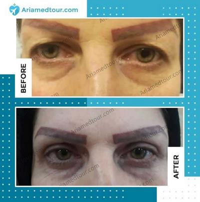 Blepharoplasty in Iran before and after photo
