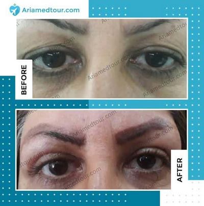 Blepharoplasty before and after photo