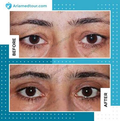 Eyelid Surgery in Iran before and after photo