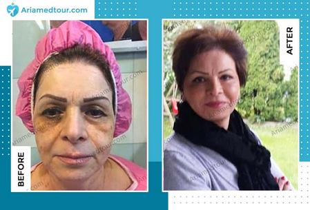 face lift surgery in Iran before after