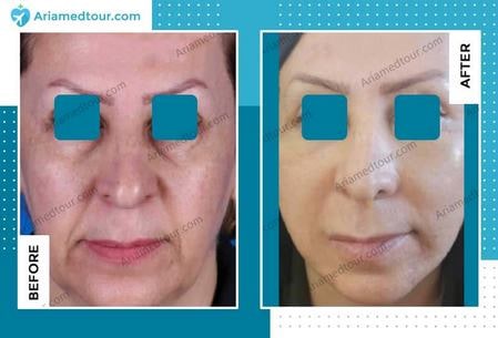 face lift surgery in Iran before after