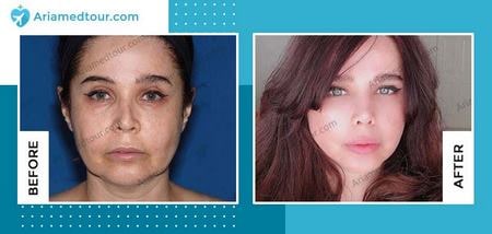 face lift before and after photo