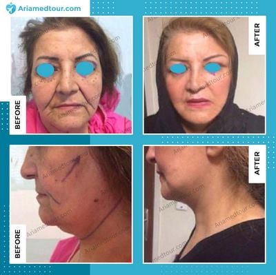 face lift surgery before and after photo in Iran