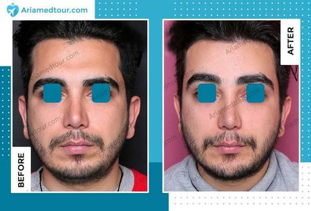 forehead contouring in Iran before after photo