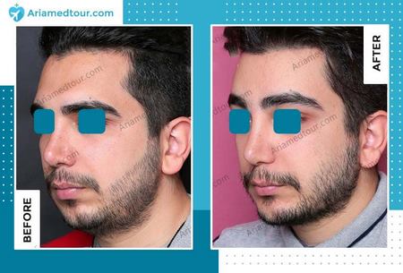 Iran forehead contouring before after photo