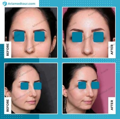 forehead contouring in Iran before after