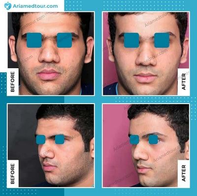 Iran forehead contouring before after photo