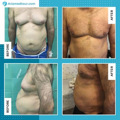 gynecomastia surgery in iran before and after