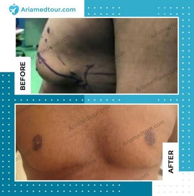 gynecomastia before and after photo in iran