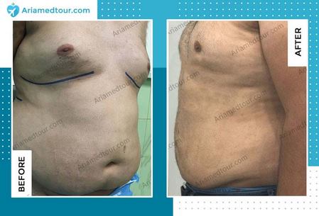 gynecomastia in iran before and after photo