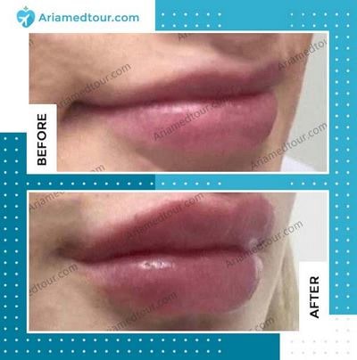 lip augmentation in Iran before and after photo