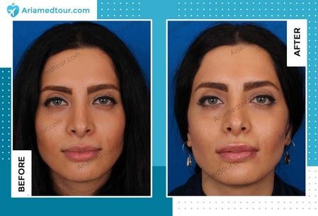 lip augmentation before after photo
