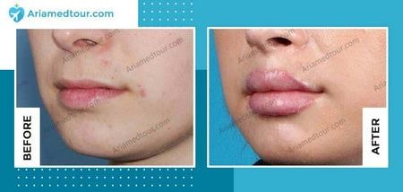 lip fillers before and after photo in Iran