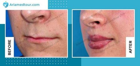 lip augmentation before and after photo in Iran