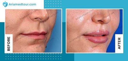 lip fillers before and after photo in Iran