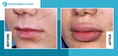 lip augmentation in Iran before and after photo