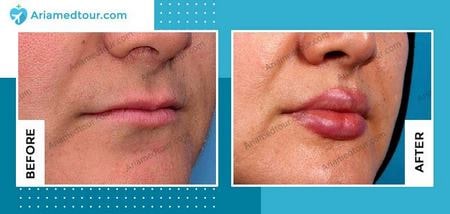 lip augmentation before after photo
