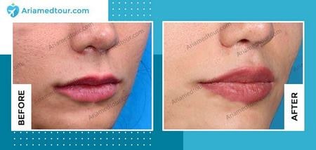 lip augmentation before and after photo in Iran