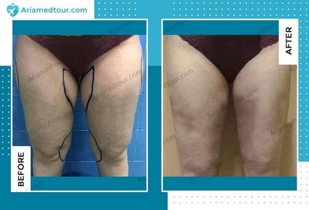 thigh lift before and after photo