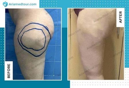 thigh lift in iran before and after photo