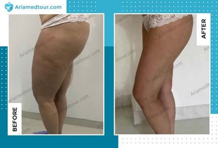 thigh lift in iran before and after photo