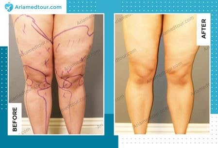 thigh lift before and after photo in Iran