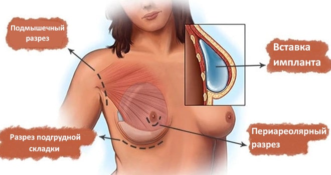 Реабилитация после увеличения груди с имплантацией