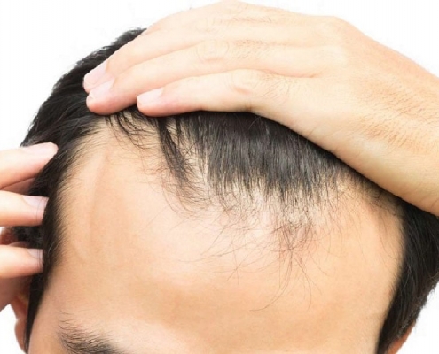 Cамые эффективные методы лечения выпадения волос
