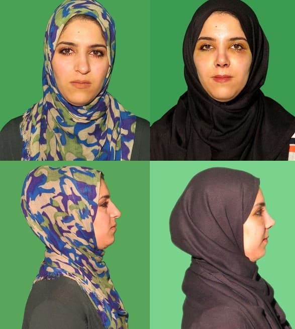 Фотографии до и после операции на нос для арабской девушкой