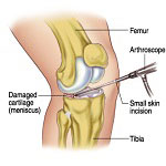 Orthopedics in Iran Orthopedics in Iran