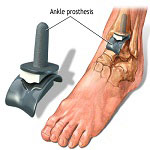 Orthopedics in Iran Orthopedics in Iran