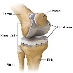 Orthopedics in Iran Orthopedics in Iran