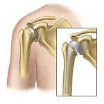 Orthopedics in Iran Orthopedics in Iran