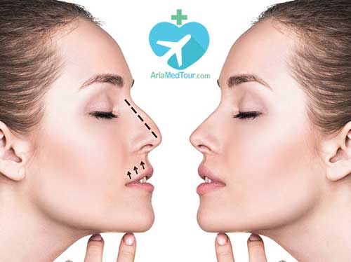 nose job before and after with ariamedtour