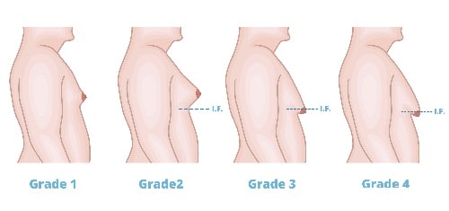Gynecomastia grades (types)